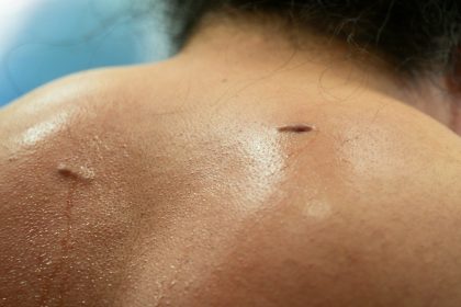 Sweaty back with two small scars