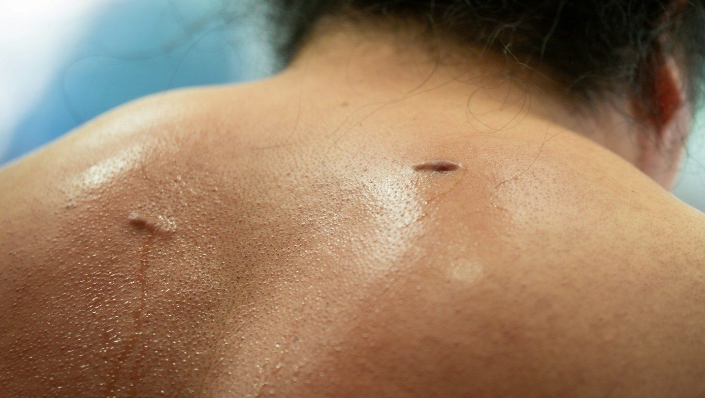 Sweaty back with two small scars